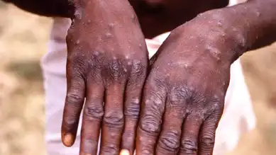 Afrika'da Maymun Çiçeği Aşılaması Başlıyor
