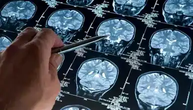 Alzheimer'da Lityum Umudu!